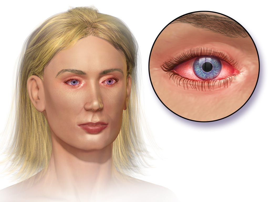 Inflammation-of-the-eye via www.arabtechnologia.com